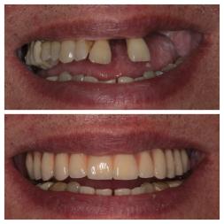 Prima e dopo il lavoro dentale