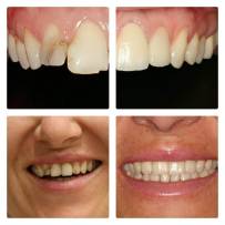 Prima e dopo il lavoro dentale - 2017