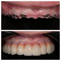 Prima e dopo il lavoro dentale - 2017